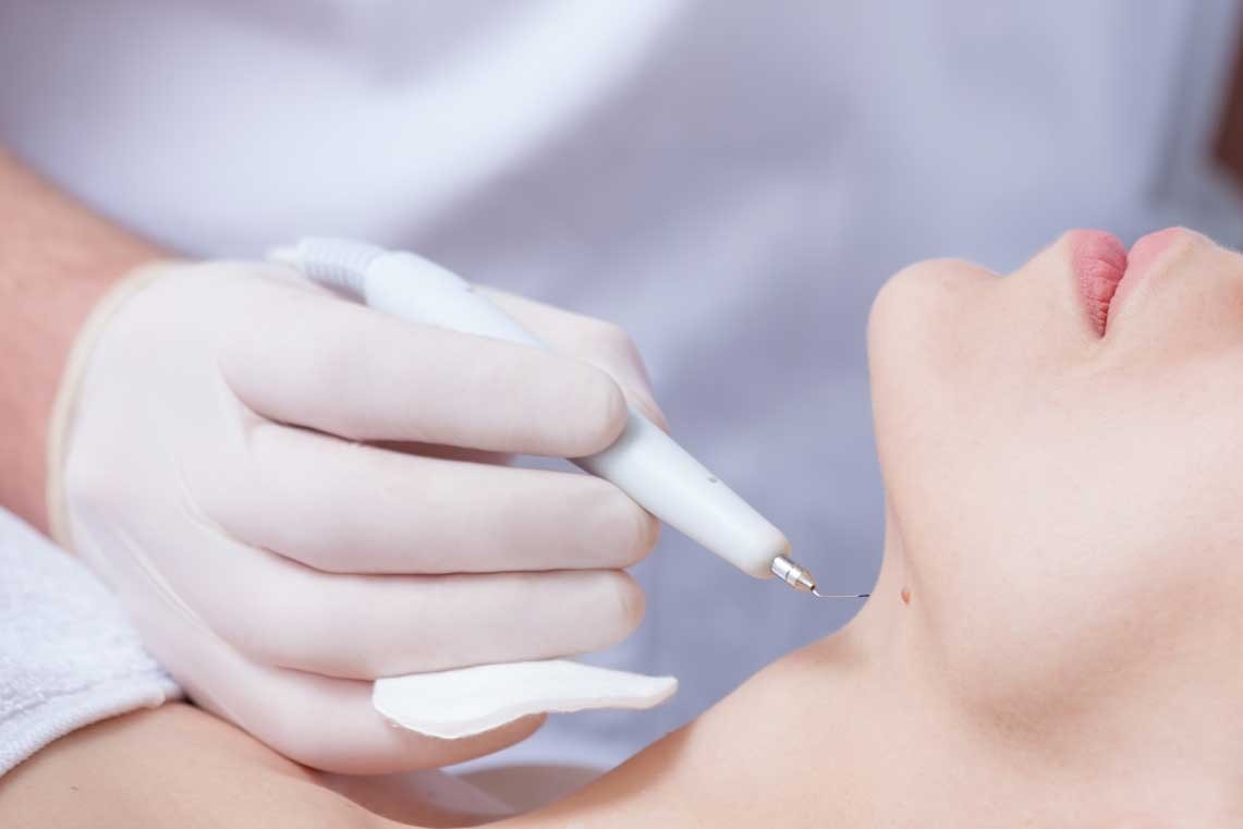Skin Wart Removal