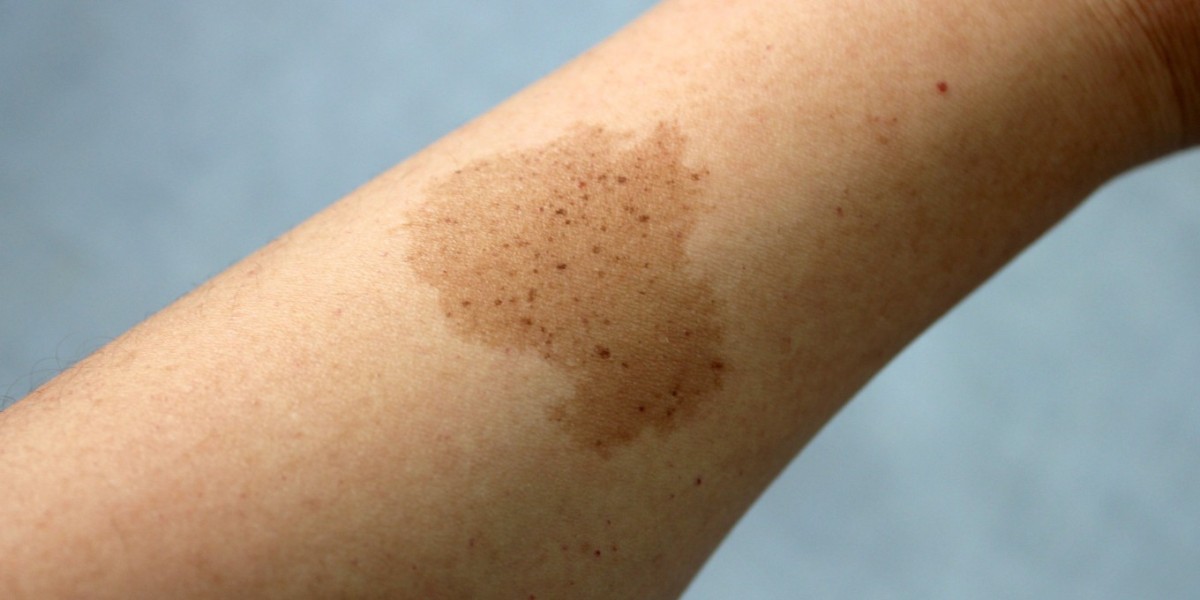 Non-Surgical vs. Surgical Birthmark Removal in Dubai: A Complete Comparison