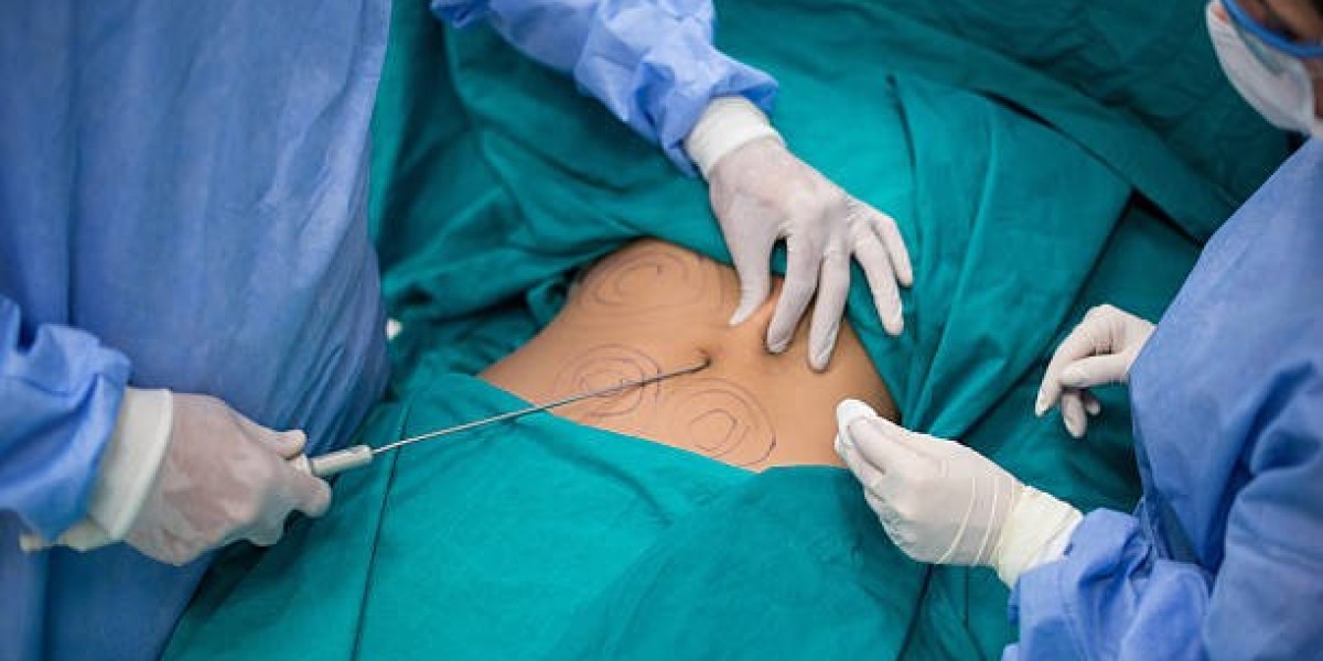 Liposuction Surgery in Dubai: How to Prepare Mentally and Physically
