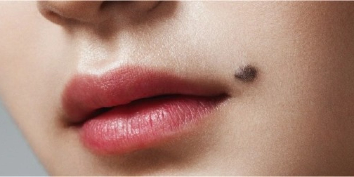 Does Mole Removal Leave a Scar?