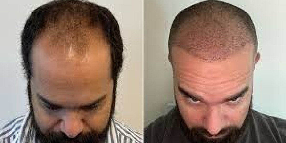 Enhance Hair Density with Scalp Micro Pigmentation – Glamorous Clinic in Dubai