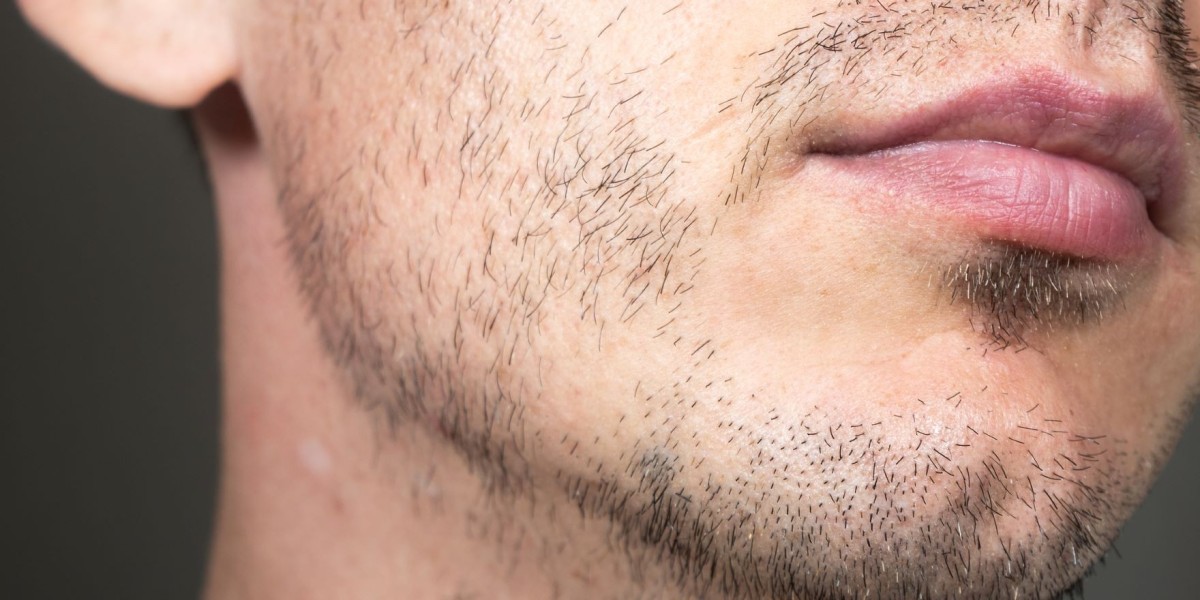 Can a Mustache Hair Transplant Fix Uneven Growth?