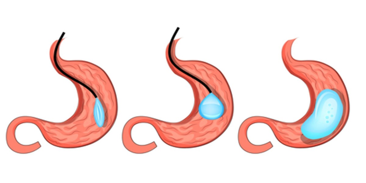 How Gastric Balloon Placement Works