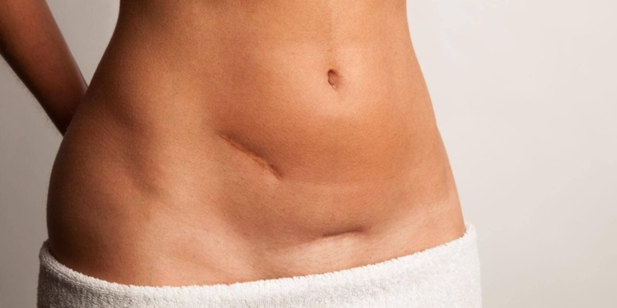 How Scar Removal in Dubai Is Helping Boost Self-Esteem