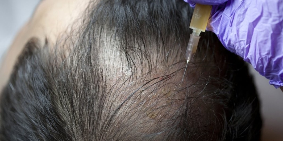 How Effective Is Stem Cell Hair Transplant For Baldness?