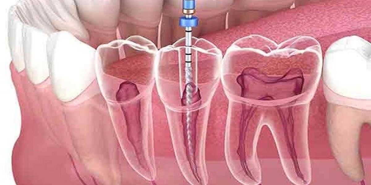 Root Canal Treatment: Preventing Infection Spread in Teeth