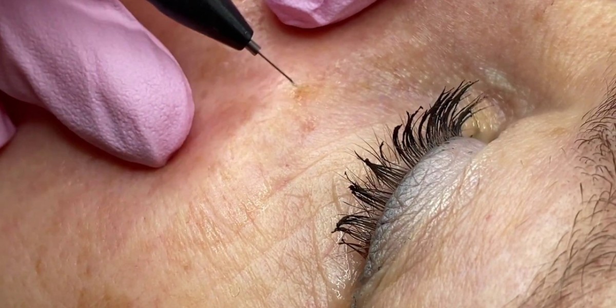 Does Wart Stage Change Skin Wart Removal Cost?