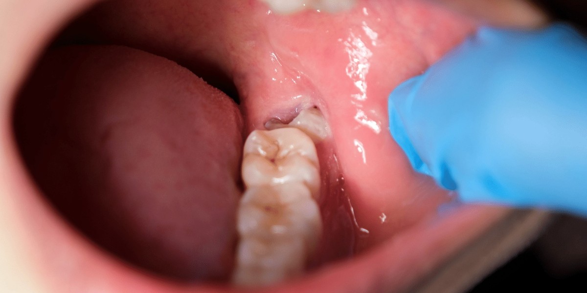 Why Some People Don’t Need Their Wisdom Teeth Removed