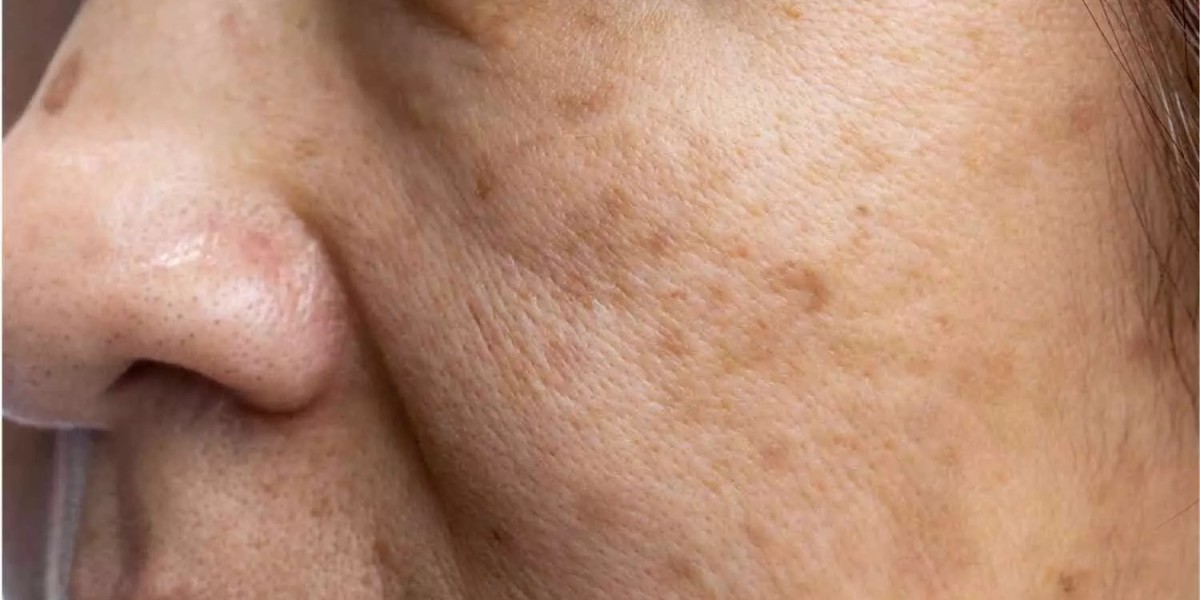 Is Pigmentation a Permanent Skin Condition?