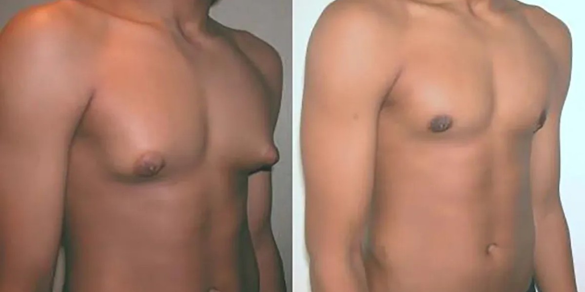 Gynecomastia Treatment in Islamabad – A Detailed Guide