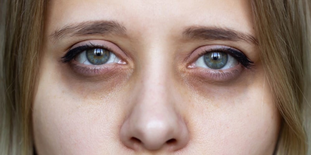 Does Face Rejuvenation Work for Dark Circles?