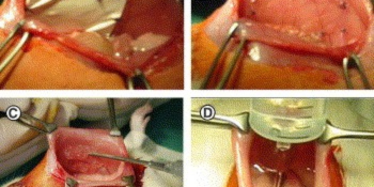Global Adhesion Barrier Market Size, Share, and Growth Analysis Report Forecast 2022 – 2032