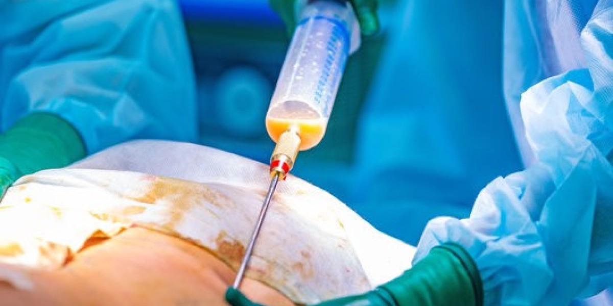 What Are the Benefits of Liposuction Treatment?