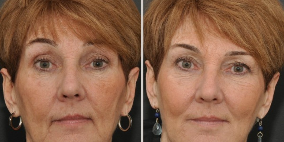 Rediscover Youth with Dermal Fillers in Islamabad
