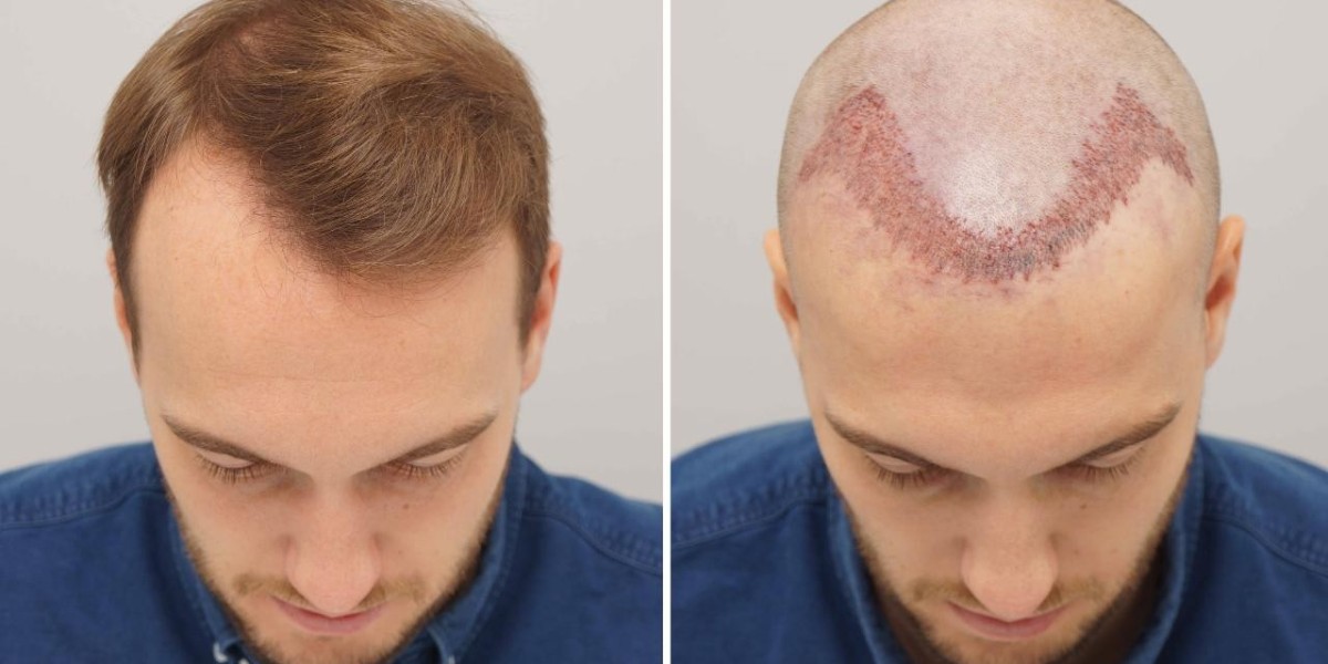 Riyadh Hair Transplant: Patient Consultation Insights
