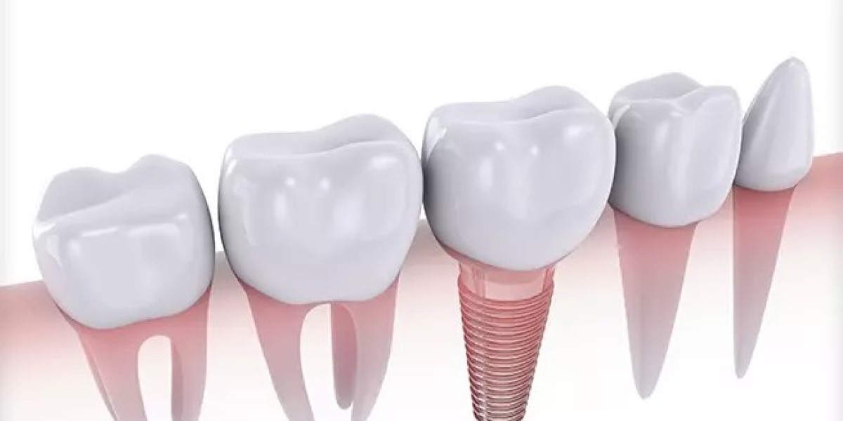 Avoiding Dental Implant Failure: Expert Tips and Insights