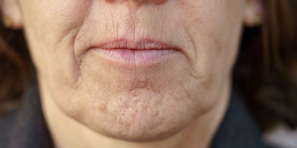 Can Juvederm Treat Marionette Lines?