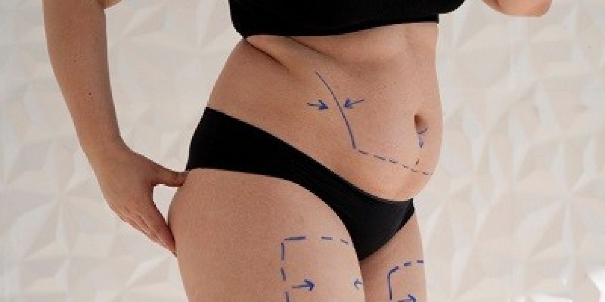 Achieve Your Ideal Body Shape with Liposuction Surgery in Riyadh