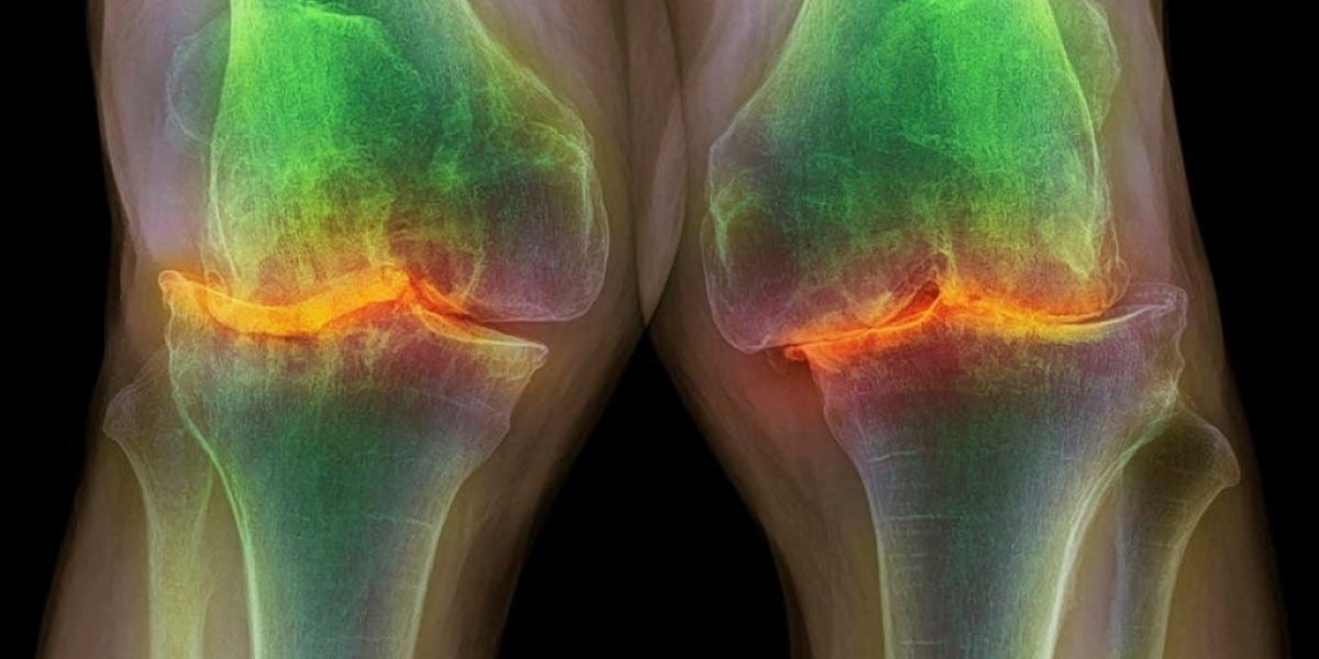 Global Knee Osteoarthritis Market Size, Trends, and Growth Strategies 2025-2032