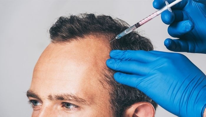 Best PRP Hair Treatment in Dubai
