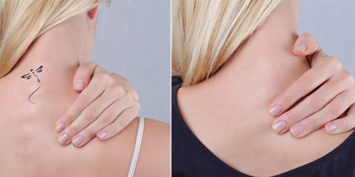 Can laser tattoo removal redefine radiance for skin that shines?