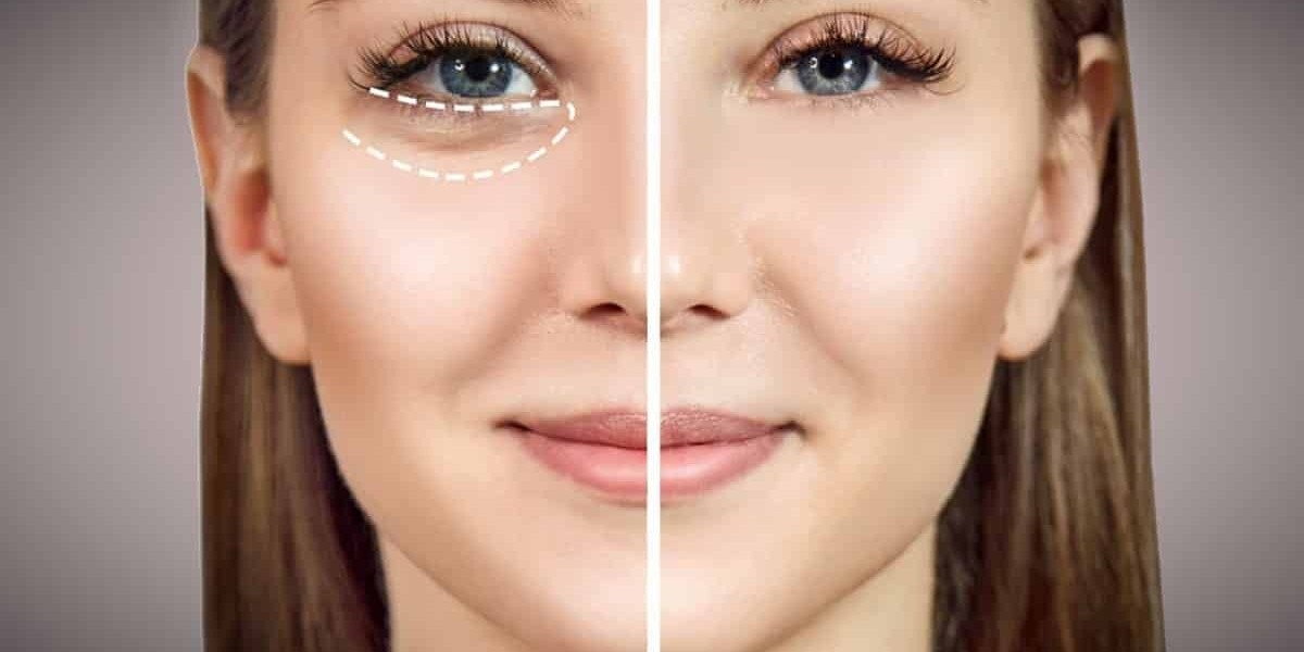 Comparing Eye Bag Removal with Botox for Under-Eye Concerns