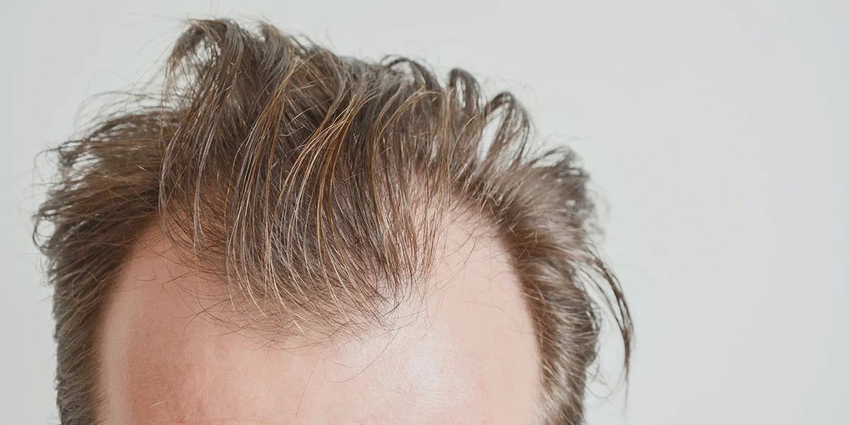 What Age Is Best to Start Finasteride for Hair Loss?
