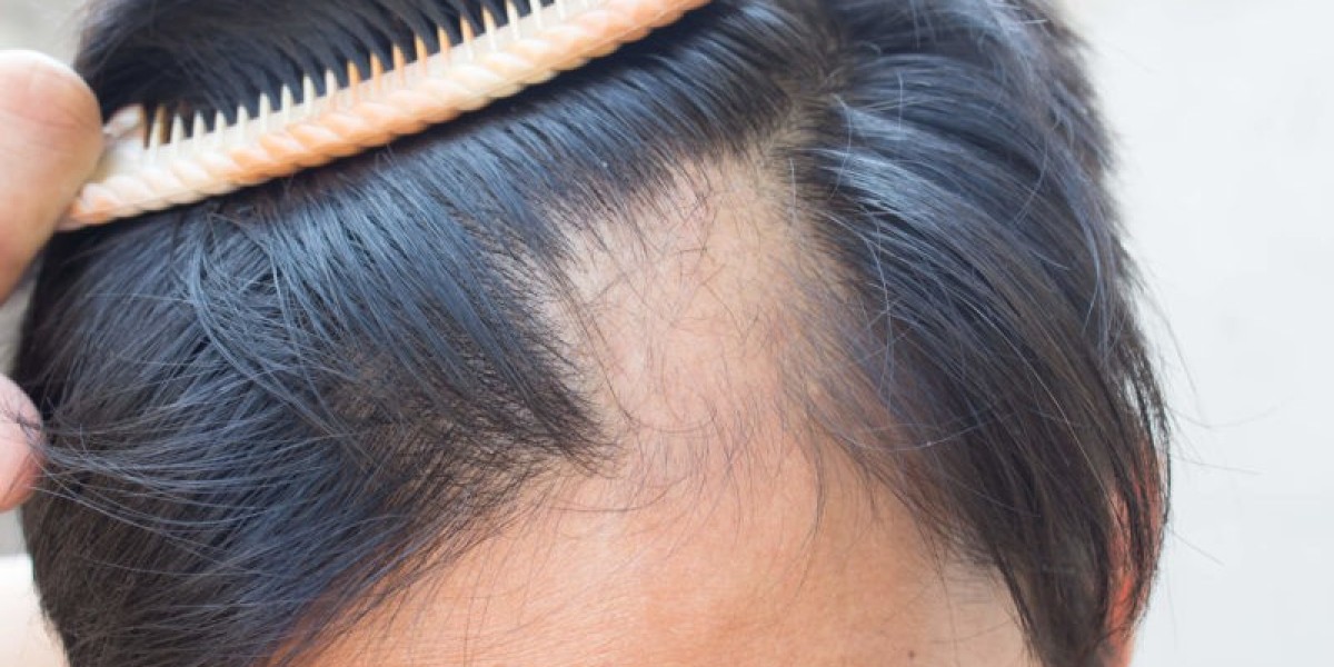 Which Hair Loss Treatments Are Suitable for All Ages?