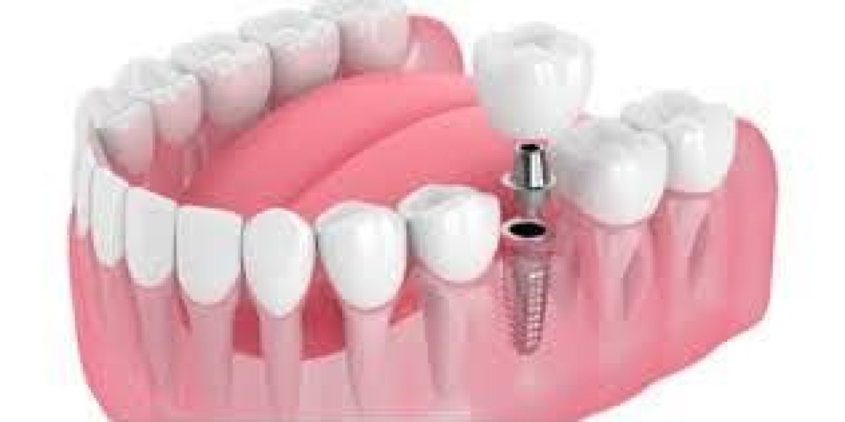 Trusted Grand Prairie Dental Implant Specialists – Book a Free Consultation