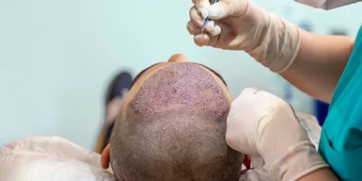 What Is FUT Hair Transplant and How Does It Work?