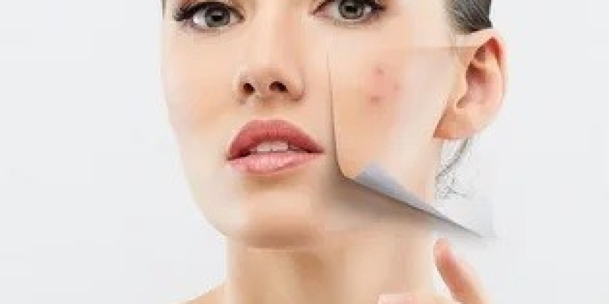 Acne Scar Treatment in Islamabad: Success Stories