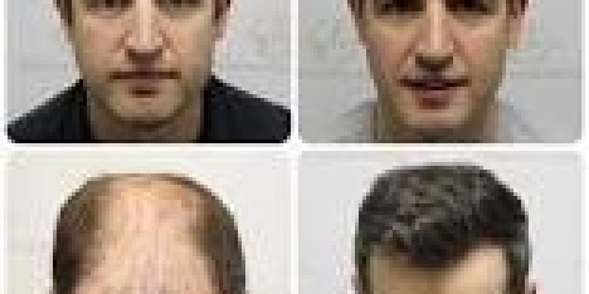 Hair Transplant London, UK - Westminster Medical Group