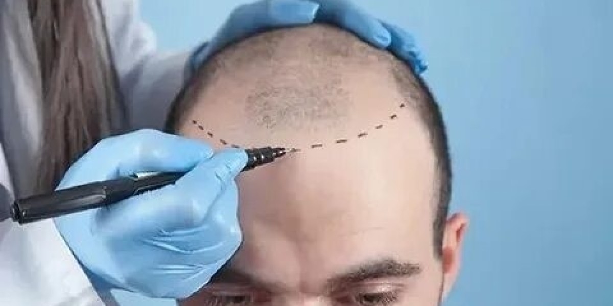 Hair Transplant in Islamabad – A Journey Towards Natural Hair Restoration