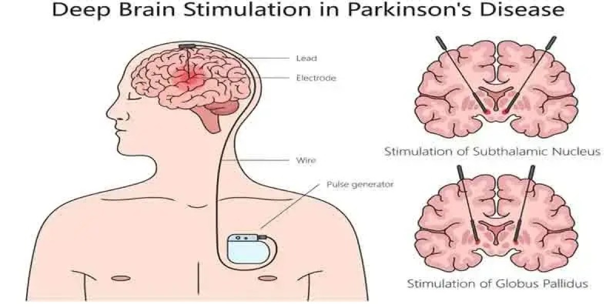 Parkinson’s Disease: Early Signs, Symptoms, and Treatments