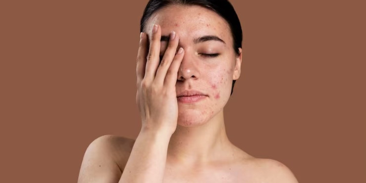 Can Melasma Treatment Appear on Body Areas Beyond the Face?