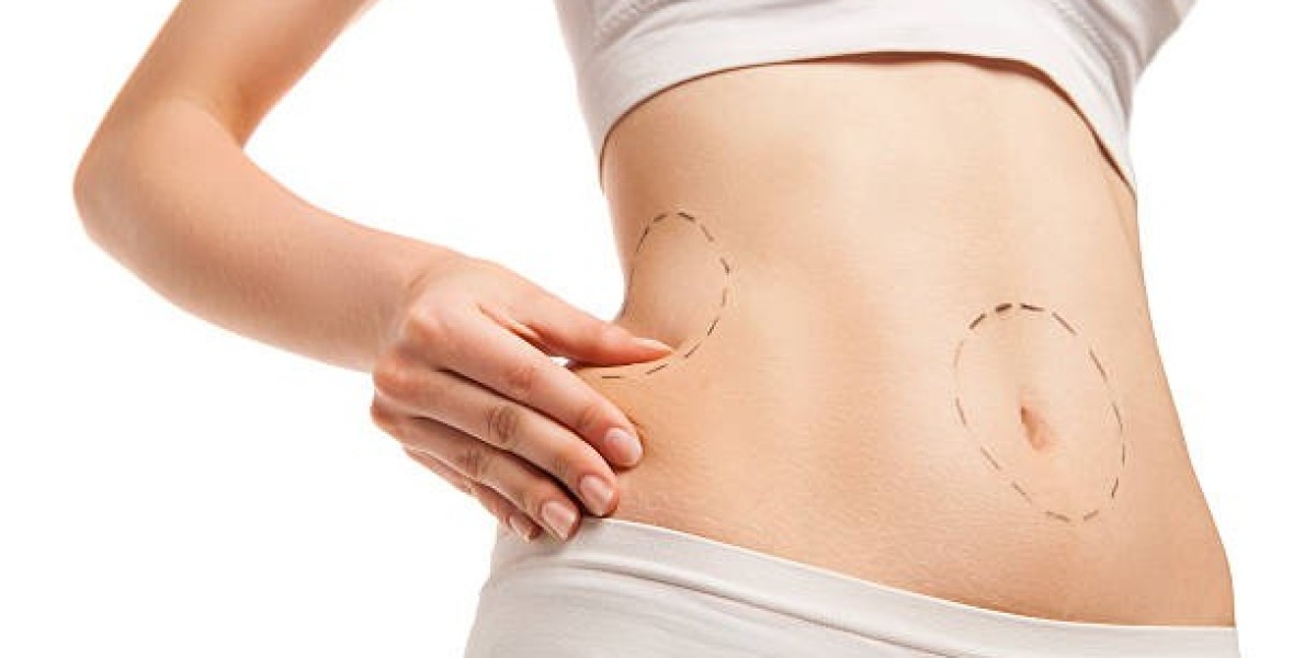 Preparing Your Home for Liposuction in Riyadh Recovery