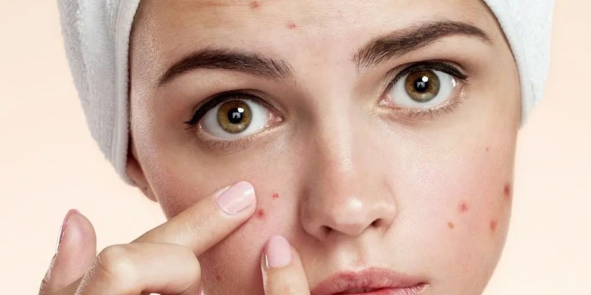 Riyadh’s Expert Picks: Best Acne Treatments