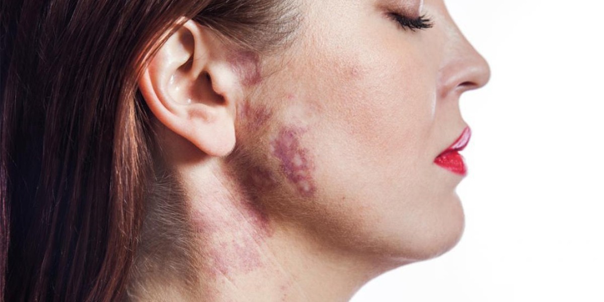 How Many Sessions are Needed for Birthmark Removal?