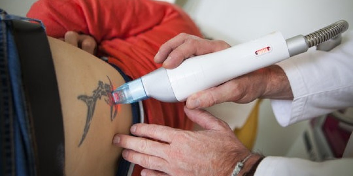 Say Goodbye to Unwanted Ink with Laser Tattoo Removal Treatment in Islamabad