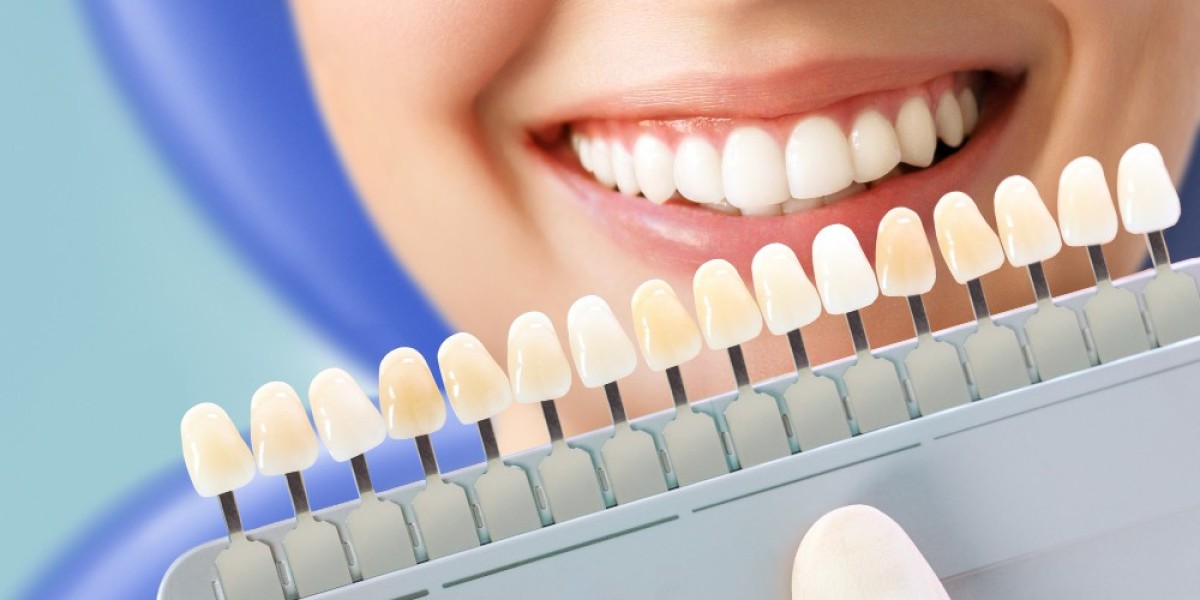 How Composite Veneers Improve Confidence and Self-Esteem