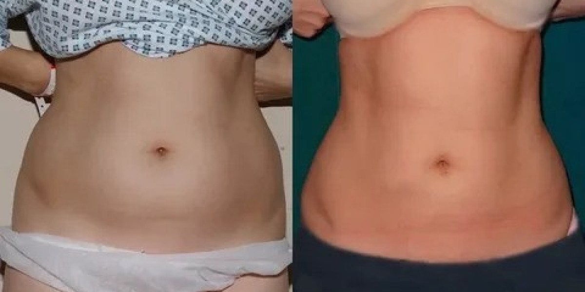Back Fat & Bra Bulge Liposuction in Islamabad – Is It Effective?