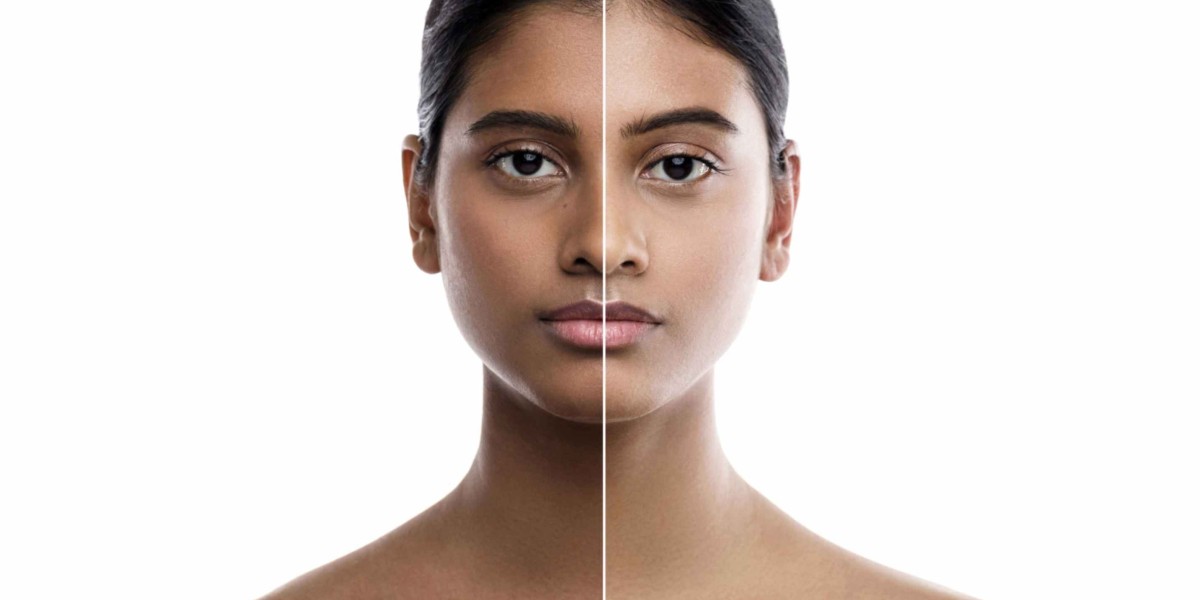 Skin Whitening Treatment Cost Structure Explained