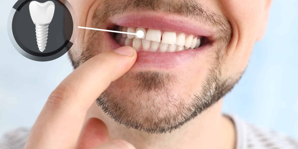 A Spark of Elegance From Timeless Dental Implants in Dubai