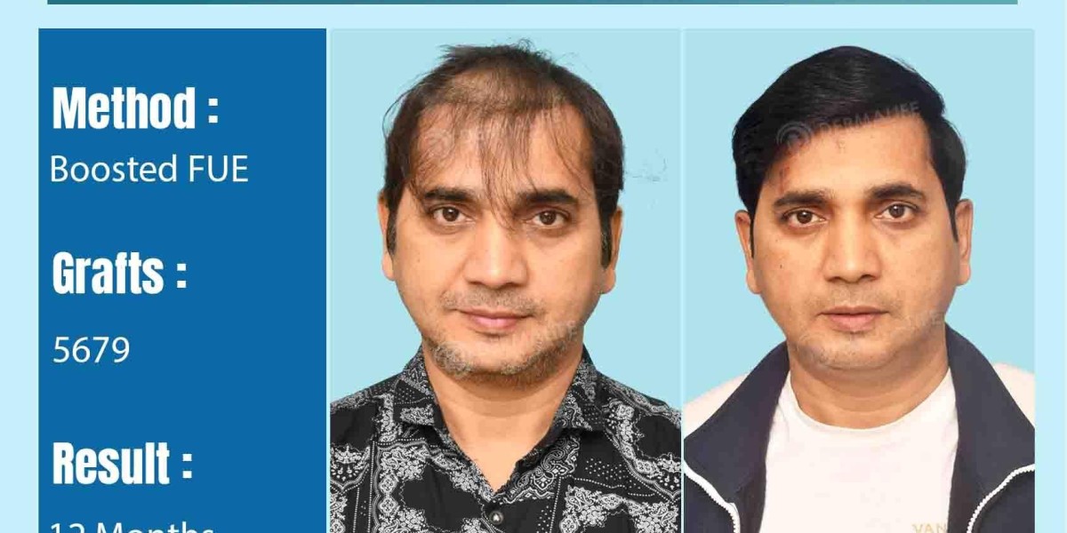 Hair Transplant in Delhi: Your Complete Guide to Cost, Surgeons, and Centers