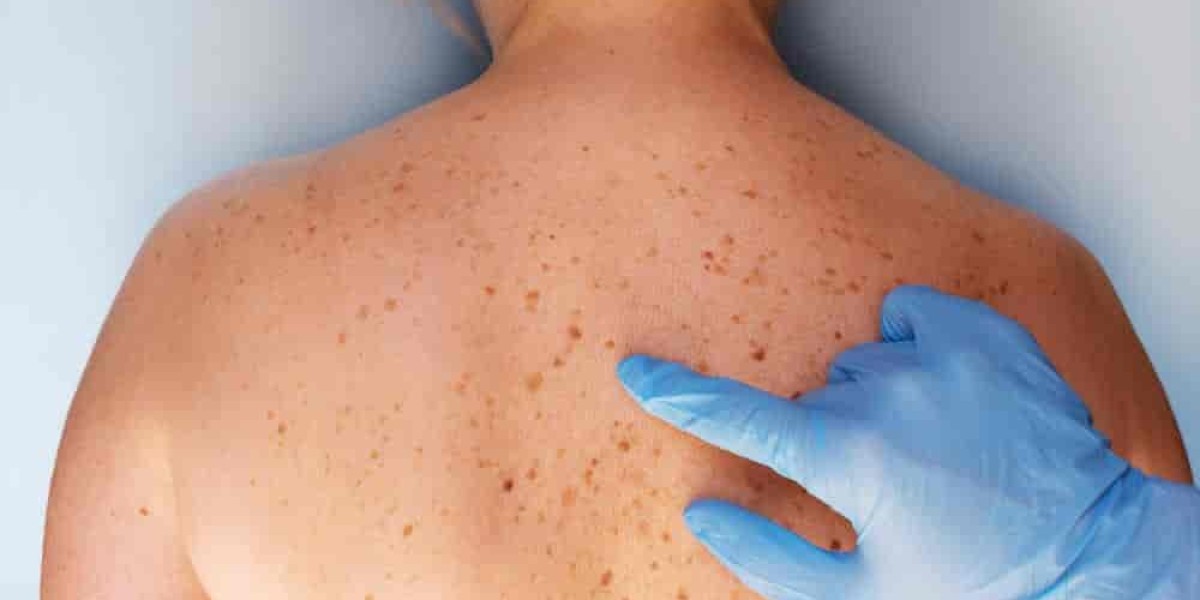 Can Birthmark Removal Treatment Improve Skin Tone?