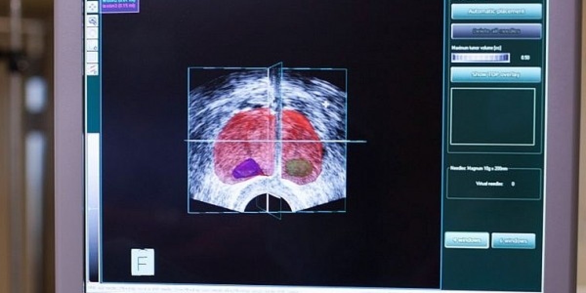Fusion Biopsy: How Technology is Revolutionizing Prostate Cancer Diagnosis