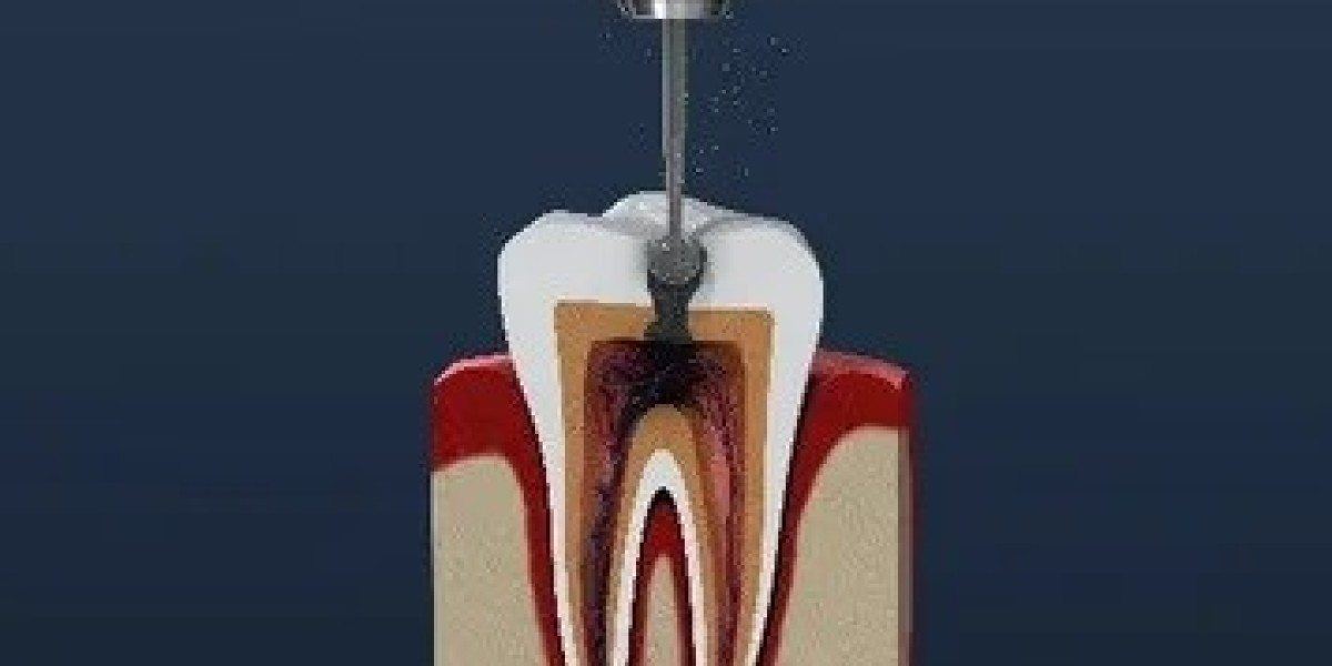 Root Canal Treatment in Islamabad: FAQs Answered