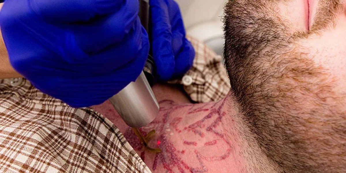 Does PicoSure Laser Tattoo Removal Hurt During Treatment?