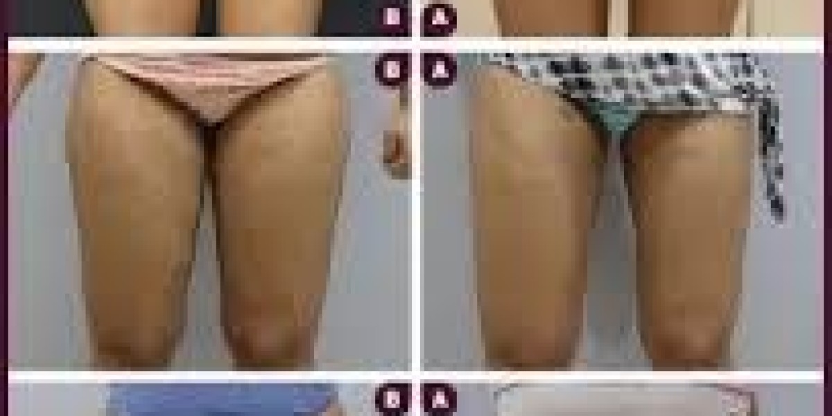 Achieve Your Ideal Body with Liposuction in Mumbai