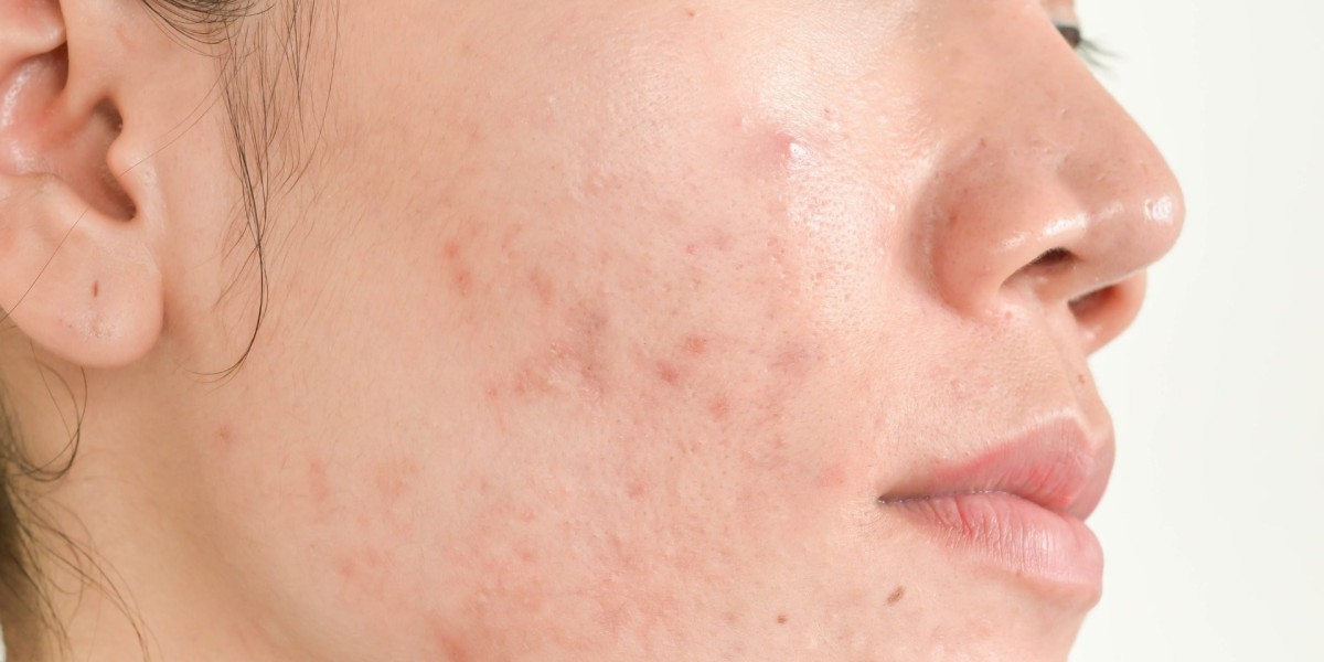Brad Pitt’s Acne Scar Treatment: The Truth Behind the Glow